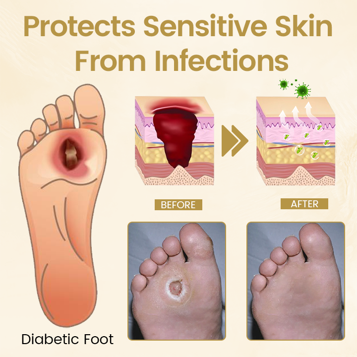 Timilk® Diabetic Foot Healing Spray - Bee Venom Infused🌟
