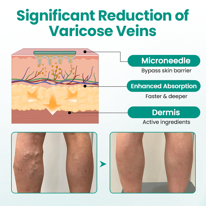 Timilk® LegRenew Varicose Veins Patch🌟