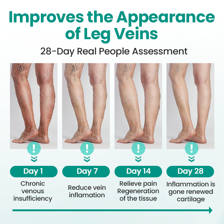 Timilk® LegRenew Varicose Veins Patch🌟
