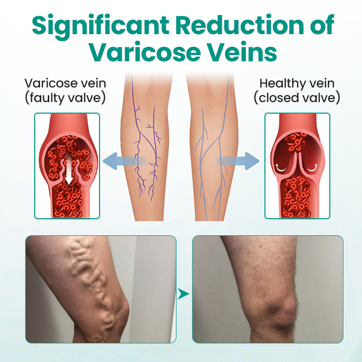 Timilk® LegRenew Varicose Veins Patch🌟