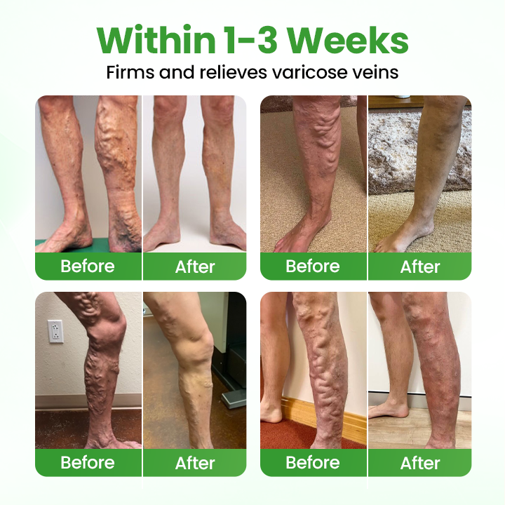 Healrize® VeinHeal Microneedle Patch🌟