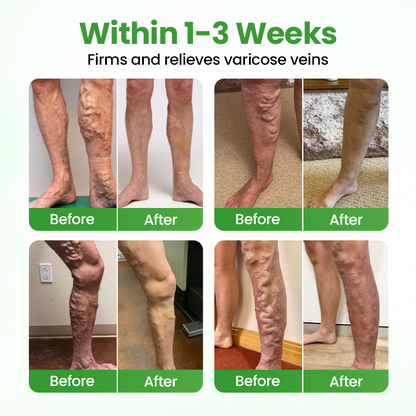 Healrize® VeinHeal Microneedle Patch🌟