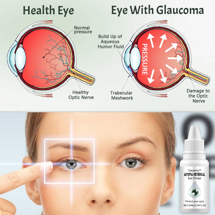Ceoerty™ Myopia Reversal Eye Drop 🌟