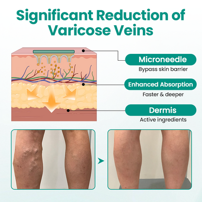 Timilk® LegRenew Varicose Veins Patch🌟