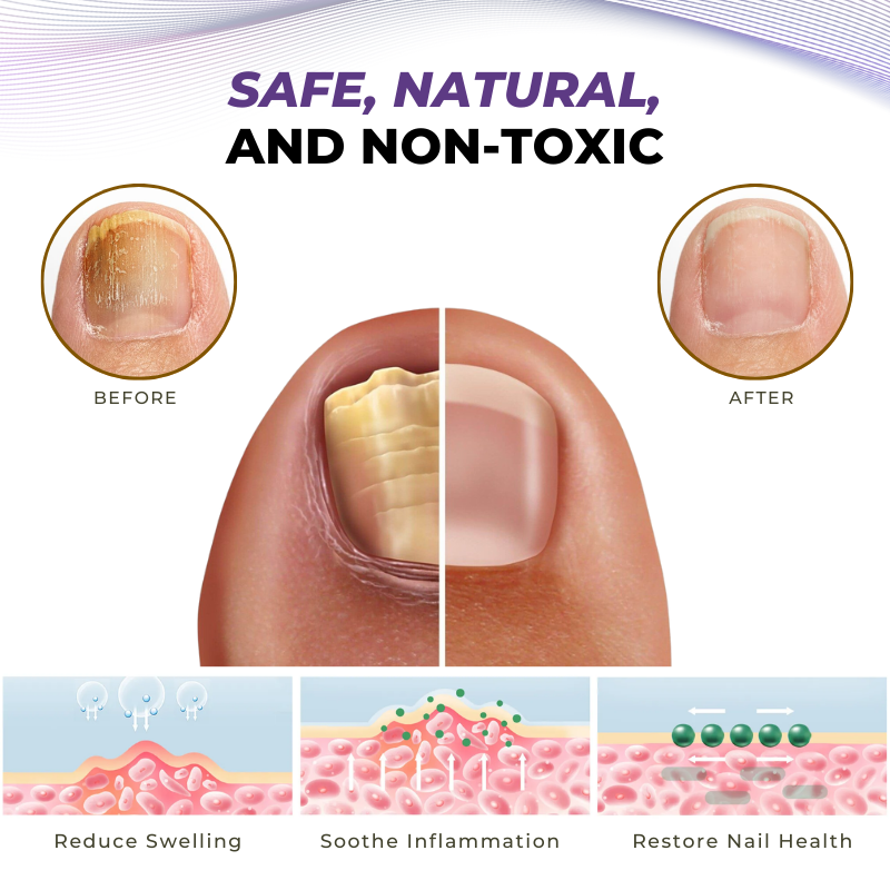 Timilk® MycoOut Natural Nail Fungus Solution