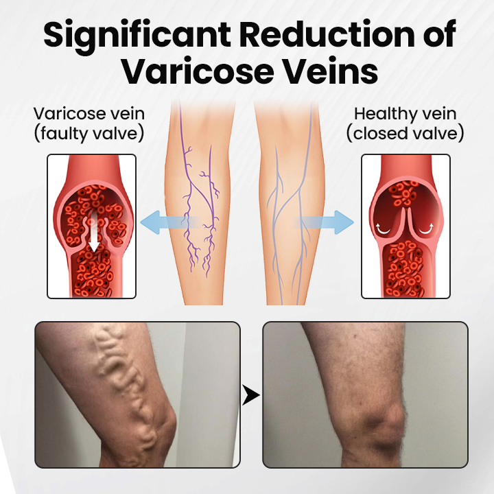 Czticle® Leg Vein Magnet Ankle Bracelet